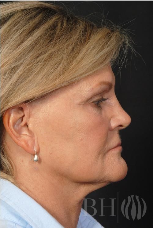 Laser Skin Resurfacing Before & After