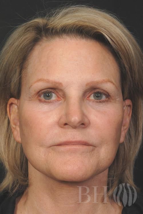 Laser Skin Resurfacing Before & After