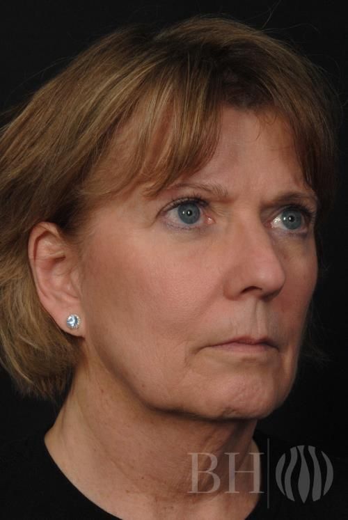 Laser Skin Resurfacing Before & After