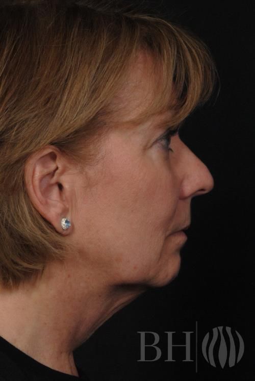 Laser Skin Resurfacing Before & After