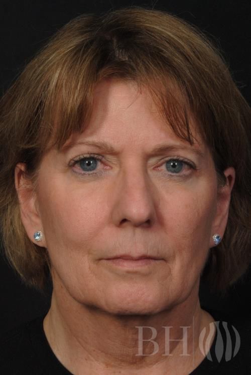 Laser Skin Resurfacing Before & After