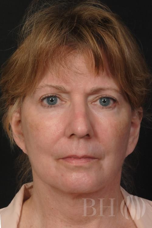 Laser Skin Resurfacing Before & After