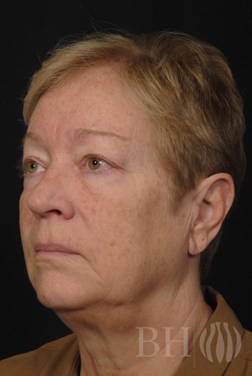 Laser Skin Resurfacing Before & After