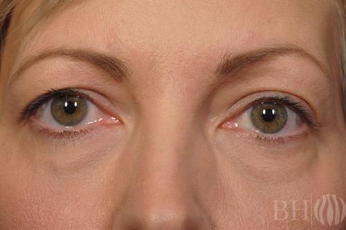 Laser Skin Resurfacing Before & After