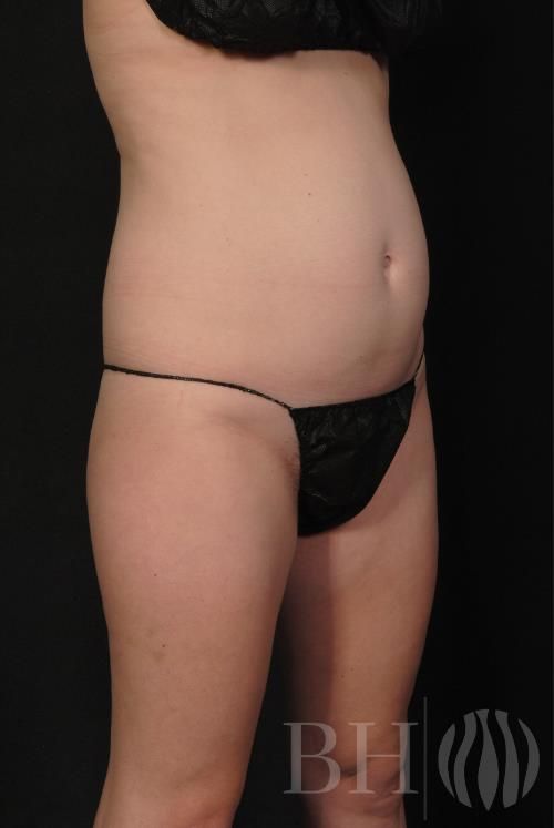Coolsculpting Before & After