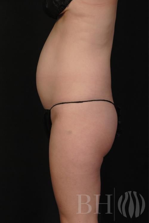 Coolsculpting Before & After