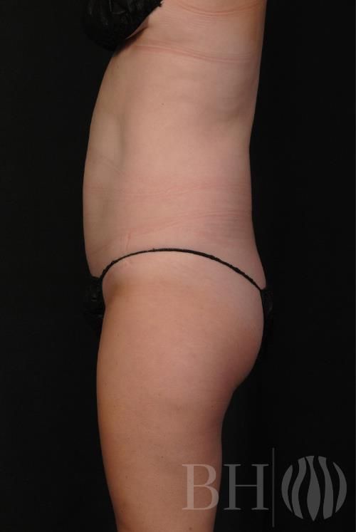Coolsculpting Before & After