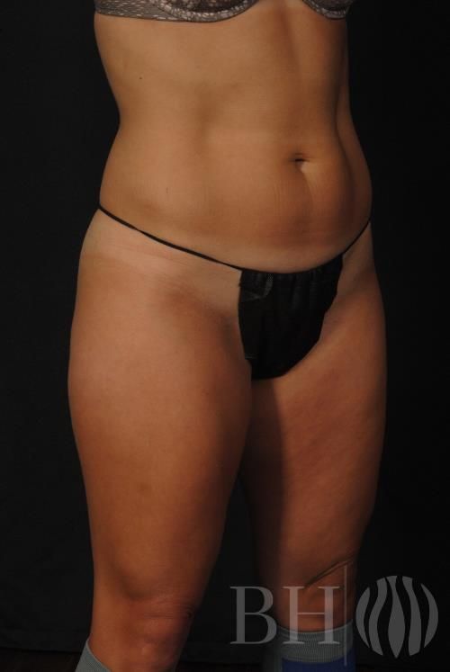 Coolsculpting Before & After