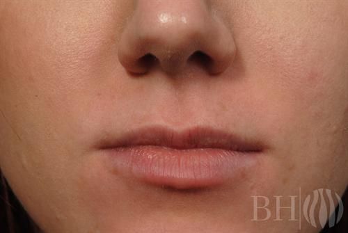 Injectables Before & After