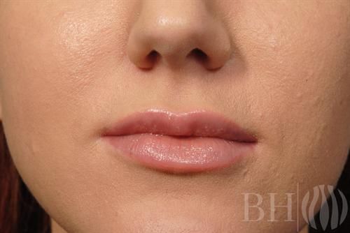 Injectables Before & After