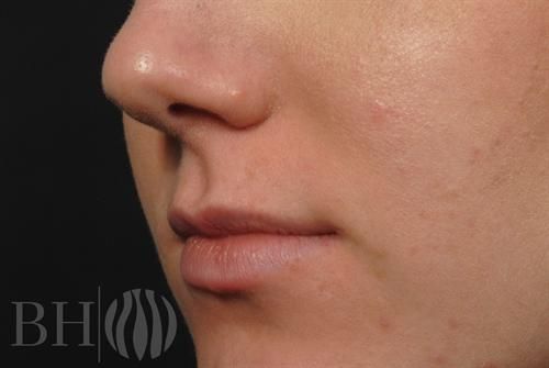 Injectables Before & After