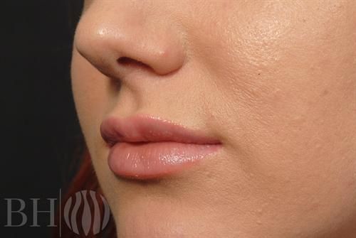 Injectables Before & After