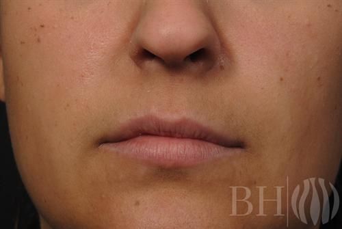 Injectables Before & After