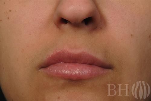 Injectables Before & After