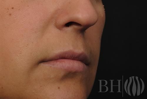 Injectables Before & After