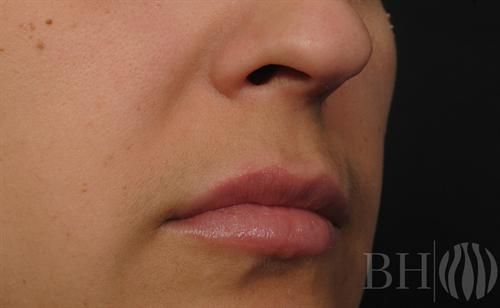 Injectables Before & After