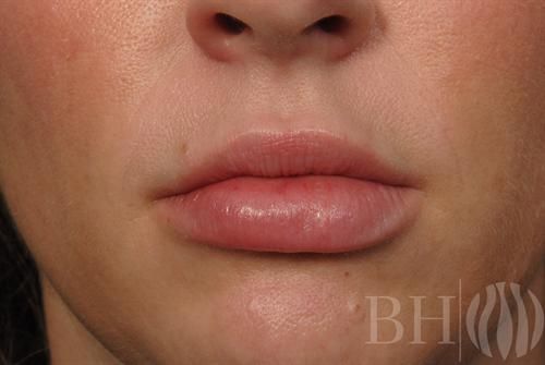 Injectables Before & After