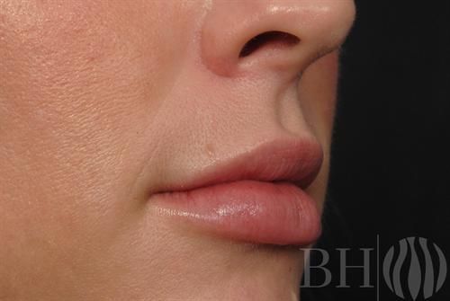 Injectables Before & After