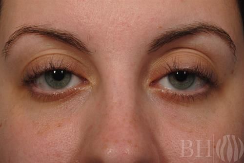 Injectables Before & After
