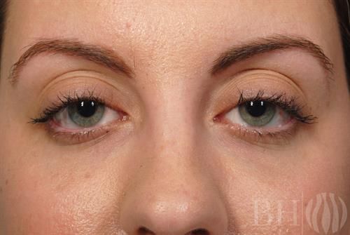 Injectables Before & After