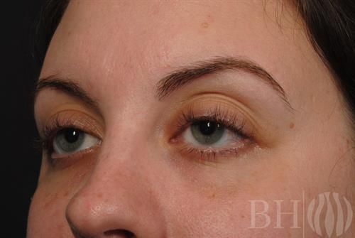 Injectables Before & After