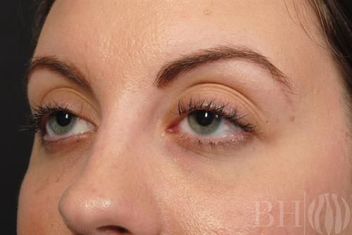 Injectables Before & After