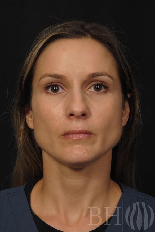 Injectables Before & After