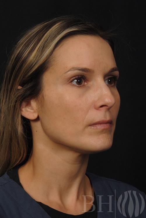 Injectables Before & After