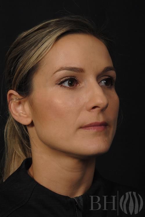 Injectables Before & After