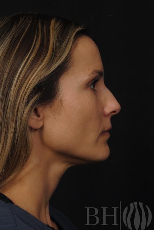 Injectables Before & After