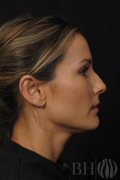 Injectables Before & After