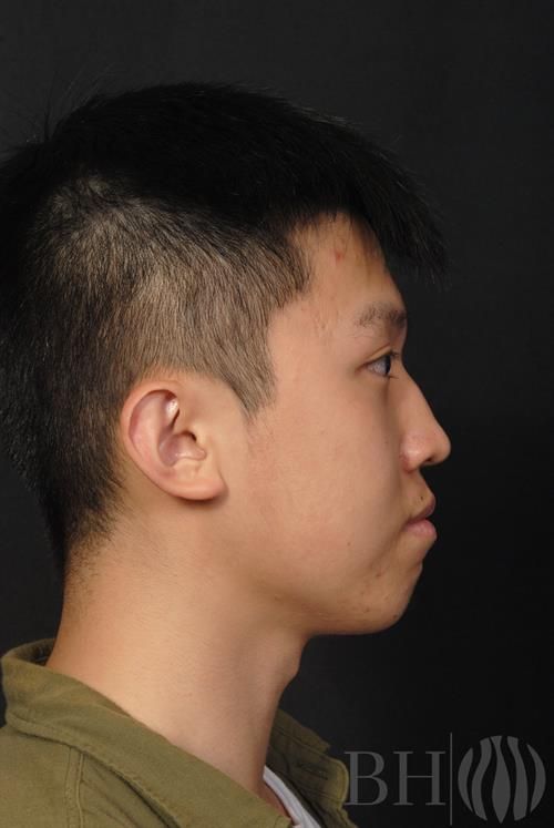 Injectables Before & After