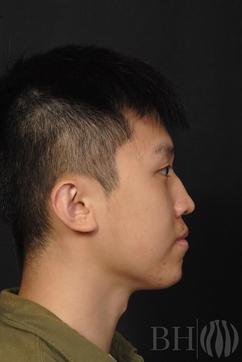 Injectables Before & After