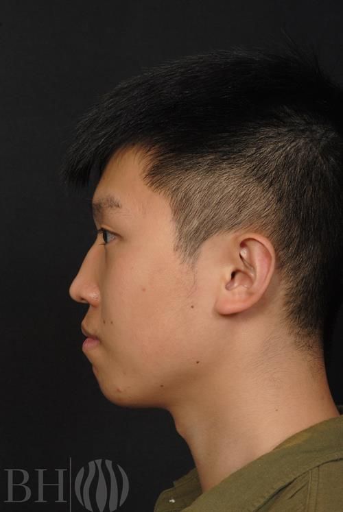 Injectables Before & After