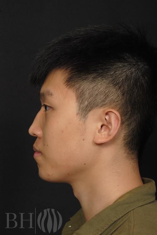 Injectables Before & After