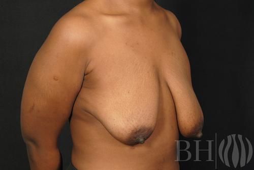 Breast Augmentation With Lift Before & After