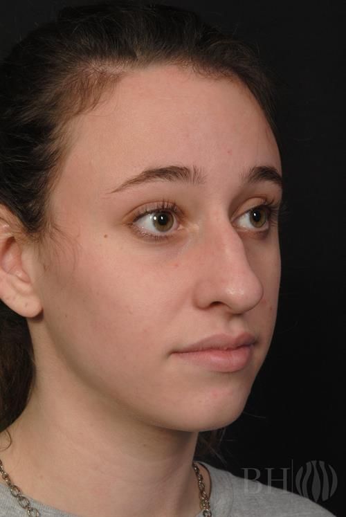 Rhinoplasty Before & After