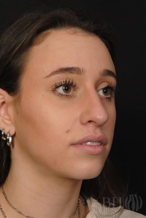 Rhinoplasty Before & After