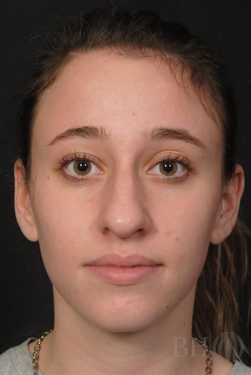 Rhinoplasty Before & After