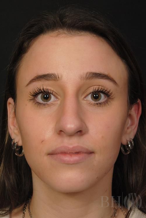 Rhinoplasty Before & After