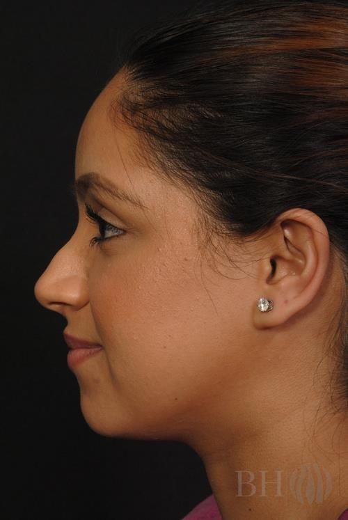 Rhinoplasty Before & After