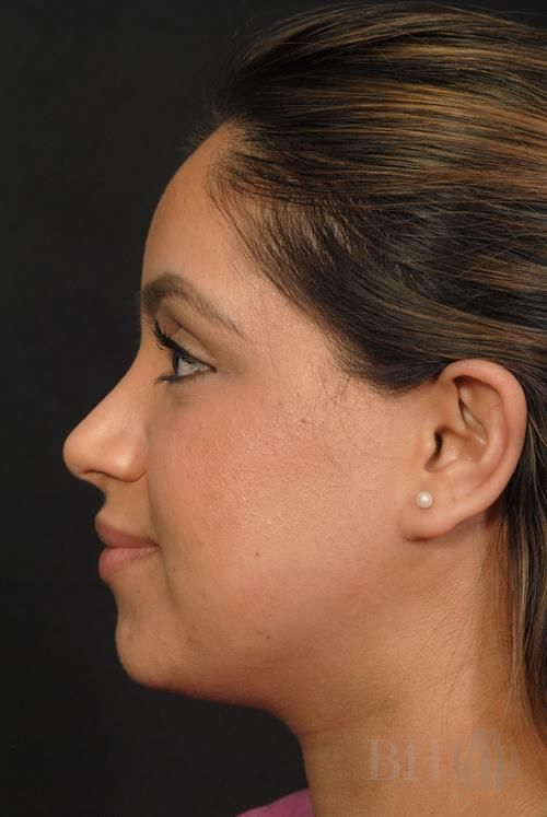 Rhinoplasty Before & After