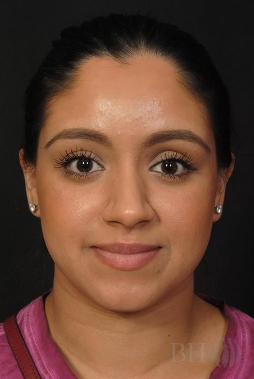 Rhinoplasty Before & After