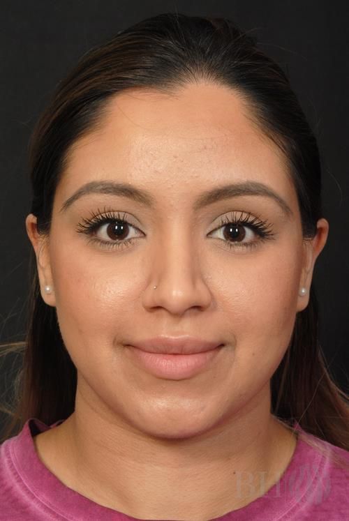 Rhinoplasty Before & After