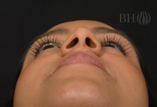 Rhinoplasty Before & After