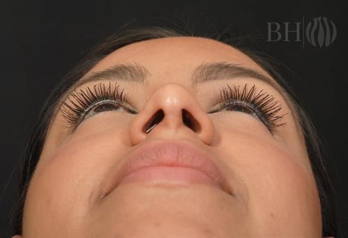 Rhinoplasty Before & After