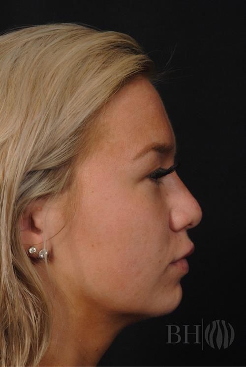 Rhinoplasty Before & After
