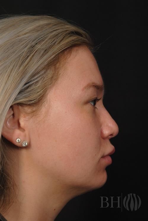 Rhinoplasty Before & After