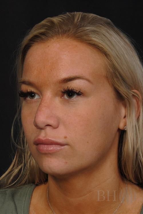 Rhinoplasty Before & After