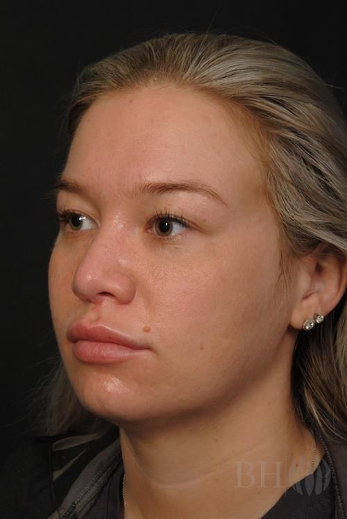 Rhinoplasty Before & After